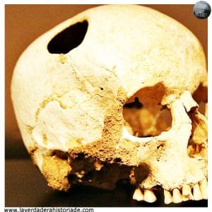 trepanaciones craneanas machu picchu